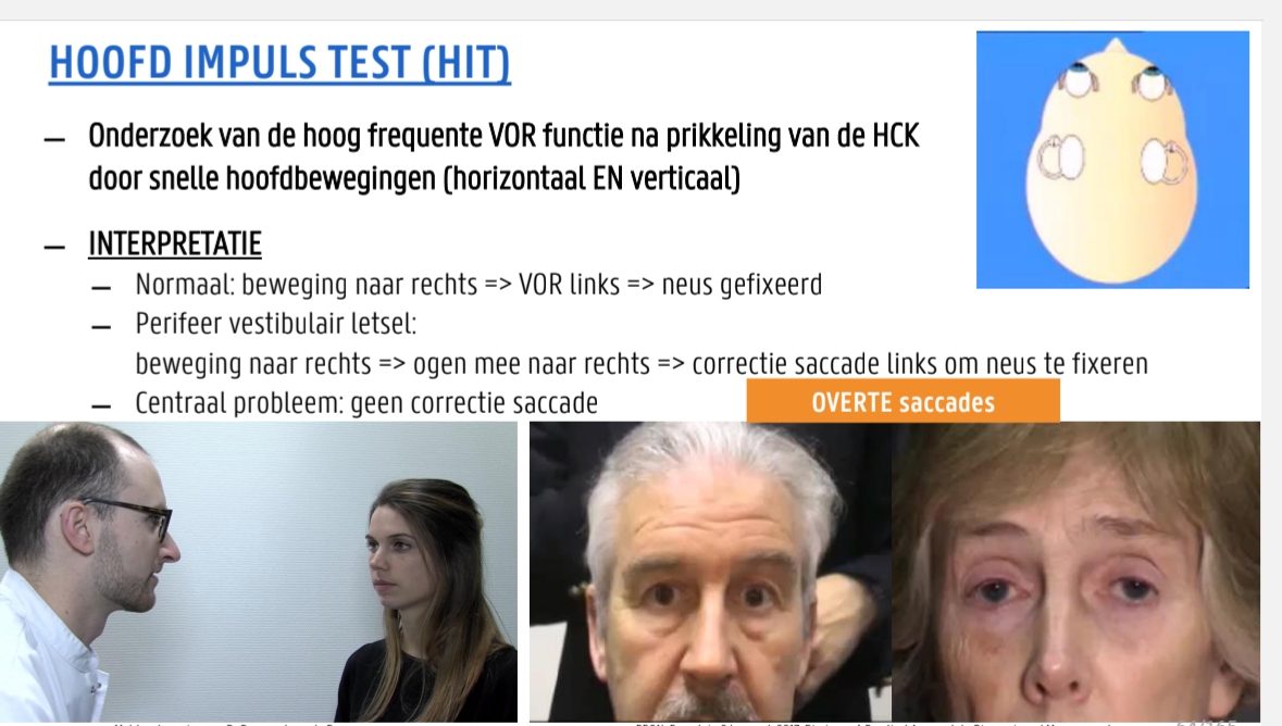 <p>Onderzoek van de hoog frequente VOR functie na prikkeling van de HCK <br>door snelle hoofdbewegingen (horizontaal EN verticaal)<br>̶ INTERPRETATIE</p><ul><li><p>Normaal: beweging naar rechts => VOR links => neus gefixeerd</p></li><li><p>Perifeer vestibulair letsel: beweging naar rechts => ogen mee naar rechts => correctie saccade links om neus te fixeren (door visueel systeem bijsturing ‘ow wacht ik moest naar de neus kijken’))</p></li><li><p>Centraal probleem: geen correctie saccade (opgelet kan ook als de persoon de ttest verkeerd verstaard of gwn staart)</p></li></ul><p>vraag patient kijk nr men neus → abrupt hoofd van links en Rechts draaien</p>