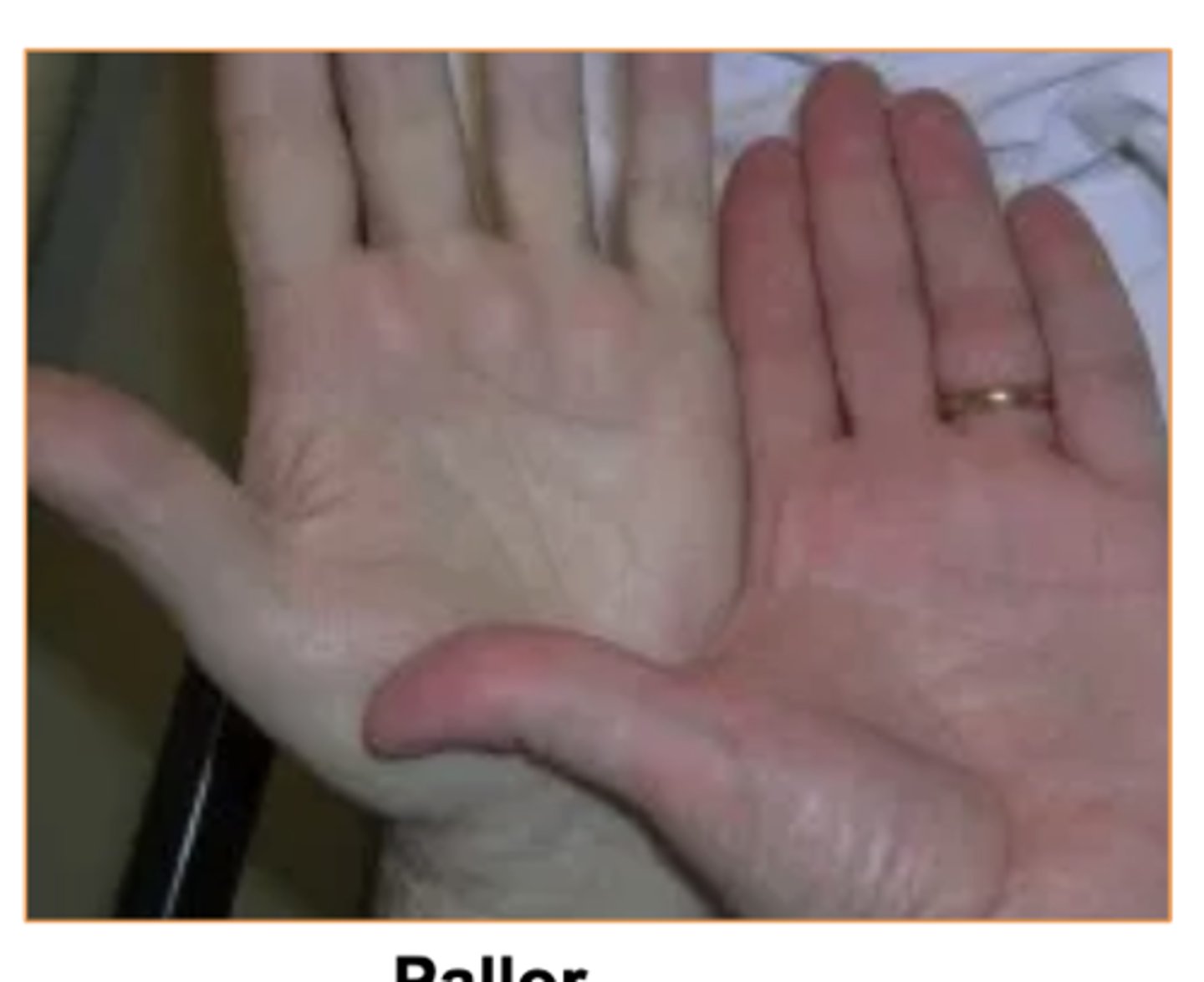 <p>decreased blood flow to skin</p><p>Some causes- Emotional stress, low blood pressure, circulatory shock, cold, anemia</p>