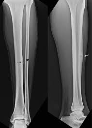 <p>caused by overuse injury; tiny fracture lines</p>