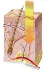 <p>Second-degree burn (partial-thickness burn)</p>
