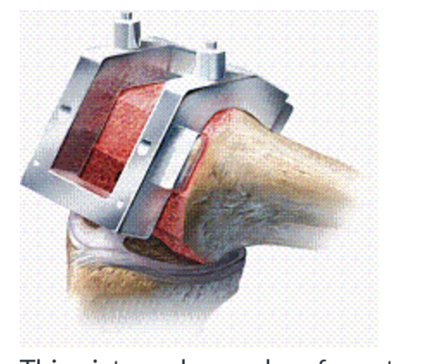<p>This picture shows chamfer cuts during Total knee Replacement ,Tibial Preparation</p>