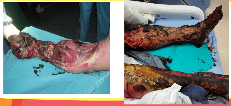 <ul><li><p>Myelopathy and encephalopathy</p></li><li><p>Sensorineural and mechanical hearing loss</p></li></ul><p></p>