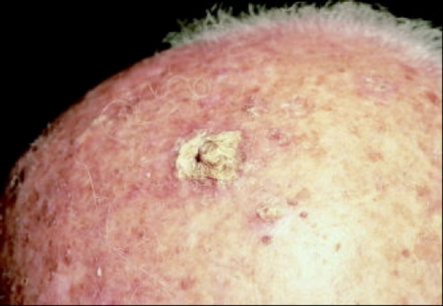 <p>precancerous conditions in which rough, scaly patches of skin develop, most commonly on sun-exposed areas such as the scalp, neck, face, ears, lips, hands, and forearms; also known as solar keratosis</p>