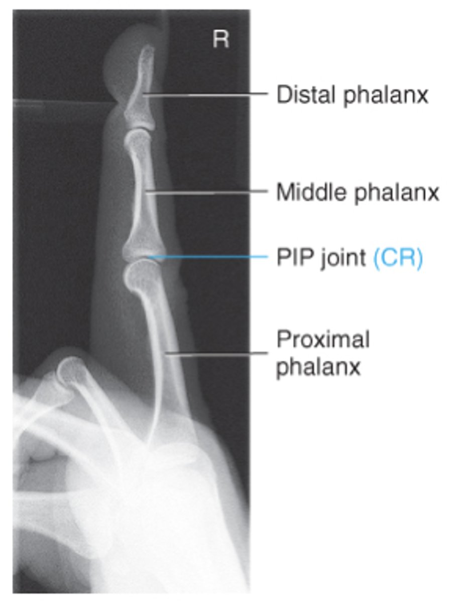 <p>-no rotation</p><p>-no superimposition of the proximal phalanx or MCP joint</p><p>-open IP joint spaces</p>