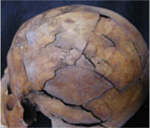 <p><span>What two types of fractures are exhibited in this skull?</span></p>