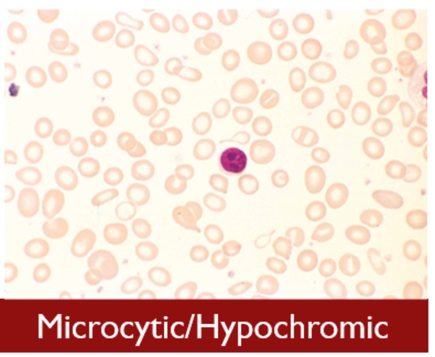 <p>Microcytic, hypochromic RBCs<br>- hgb &lt;10 mg/dL<br>- high RDW<br>- reticuloytes</p>