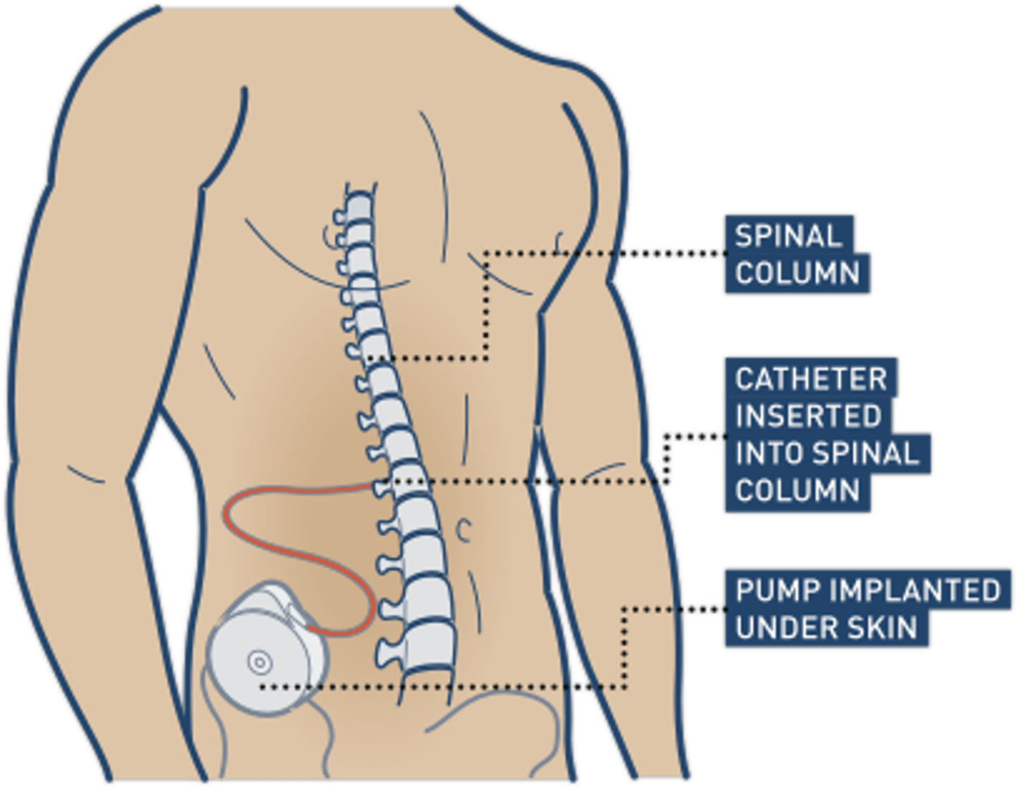 <p>Mech: on CNS</p><p>Use: Muscle spasticity in pt with MS, SCI and CO</p><p>SE</p><p>-hypotonia</p><p>-confusion</p><p>-increased risk of falls</p><p>-shallow breathing</p><p>Tx: orally or intrathecally</p>