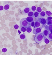 <p>Apocrine gland of the anal sac adenocarcinoma</p>