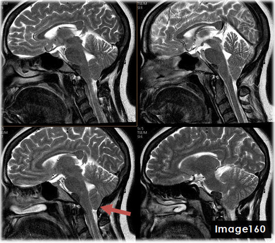 <p>The red arrow in Image 160 points to what pathology?</p>
