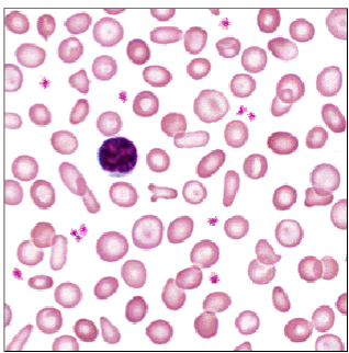 <p>Low ferritin level is the most sensitive index of early iron deficiency</p><p>Low RBC count</p><p>Low haemoglobin</p><p>Low haematocrit</p><p>Erythrocytes may be microcytic …→</p><p>Low Mean Corpuscular Volume (MCV)</p><p>Erythrocytes may be hypochromic</p><p>Low Mean Corpuscular Haemoglobin (MCH)</p><p>Target cells and pencil cells</p>