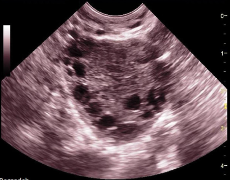 <p>pt has amenorrhea + hirsutism. if the right ovary has the same appearance, </p><p>a) normal ovary w/multiple follicles</p><p>b) partial ovarian torsion</p><p>c) ovarian hyperstimulation</p><p>d) possible stein-leventhal syndrome </p>