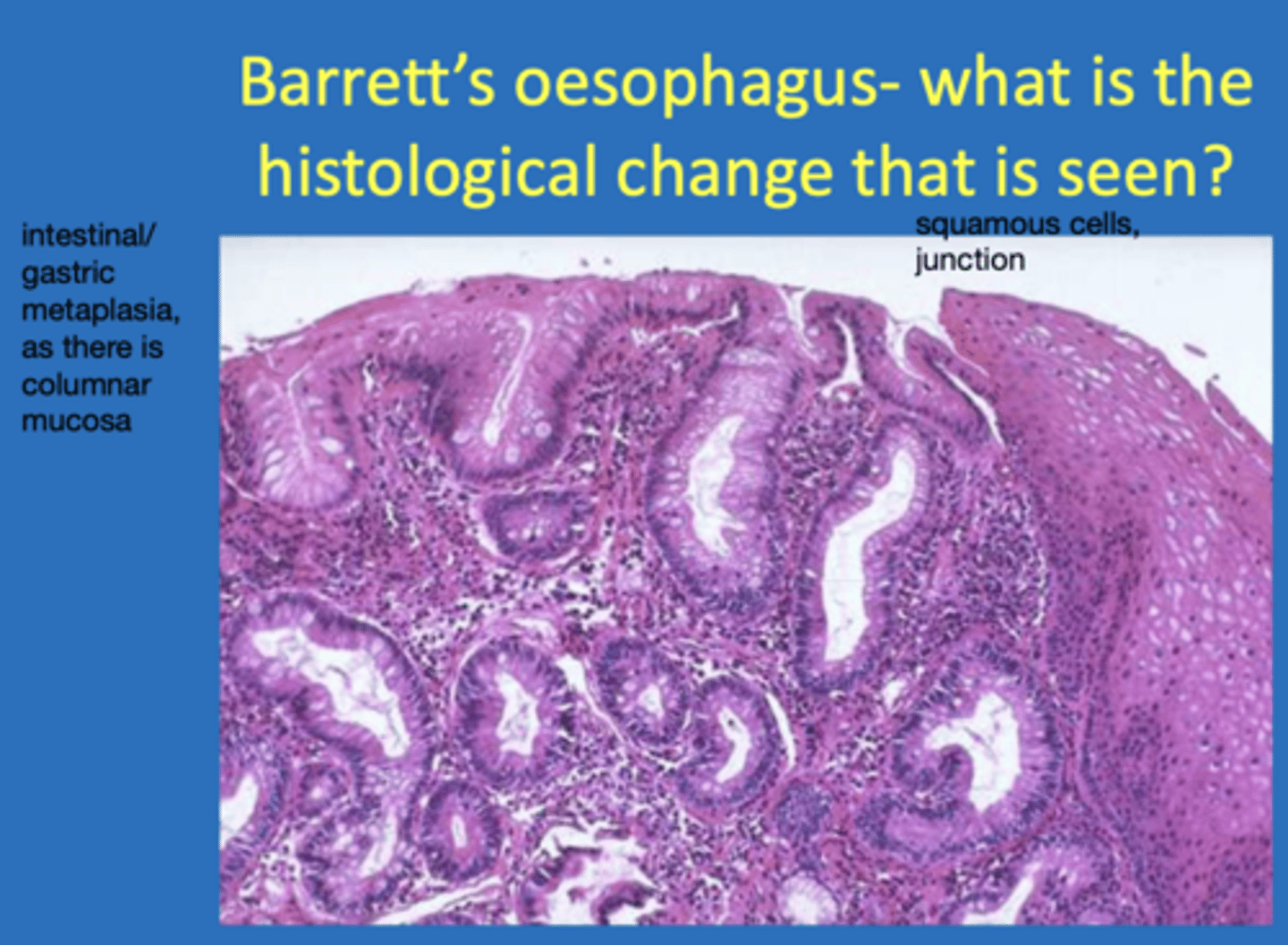 <p>barrett's oesophagus - the cells at the lower end change from stratified squamus to columnar</p>
