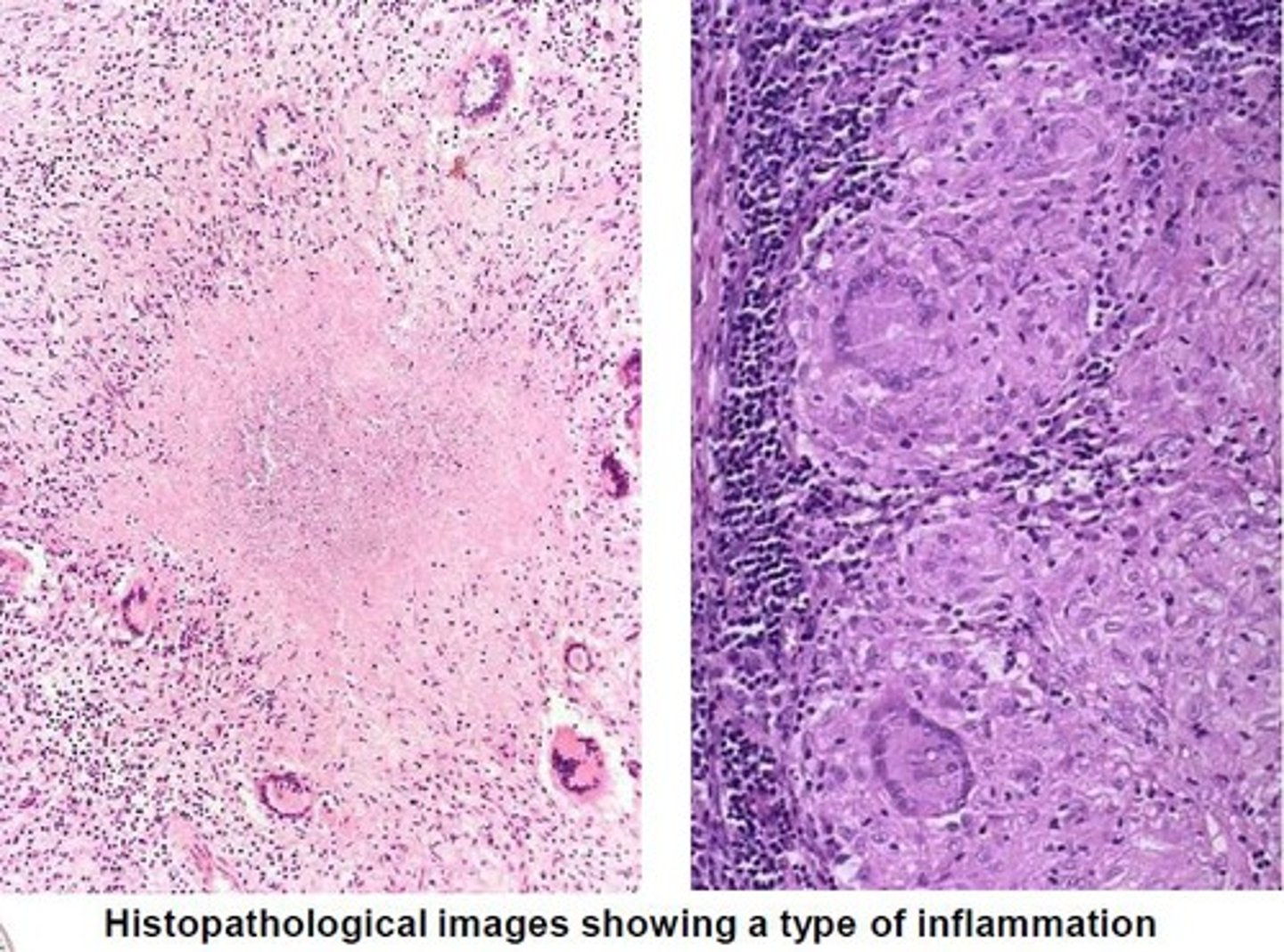 <p>What are often causes of Granulomatous Inflammation?</p>