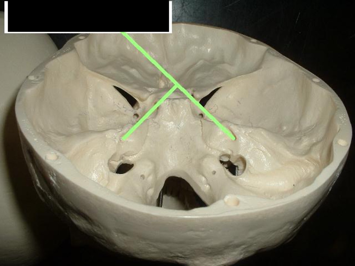 <p>the back side of the petrous portion that runs into the ear hole</p>
