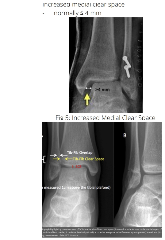 <p>Sydesmosis Sprain “High Ankle Sprain” X-Ray Findings</p>