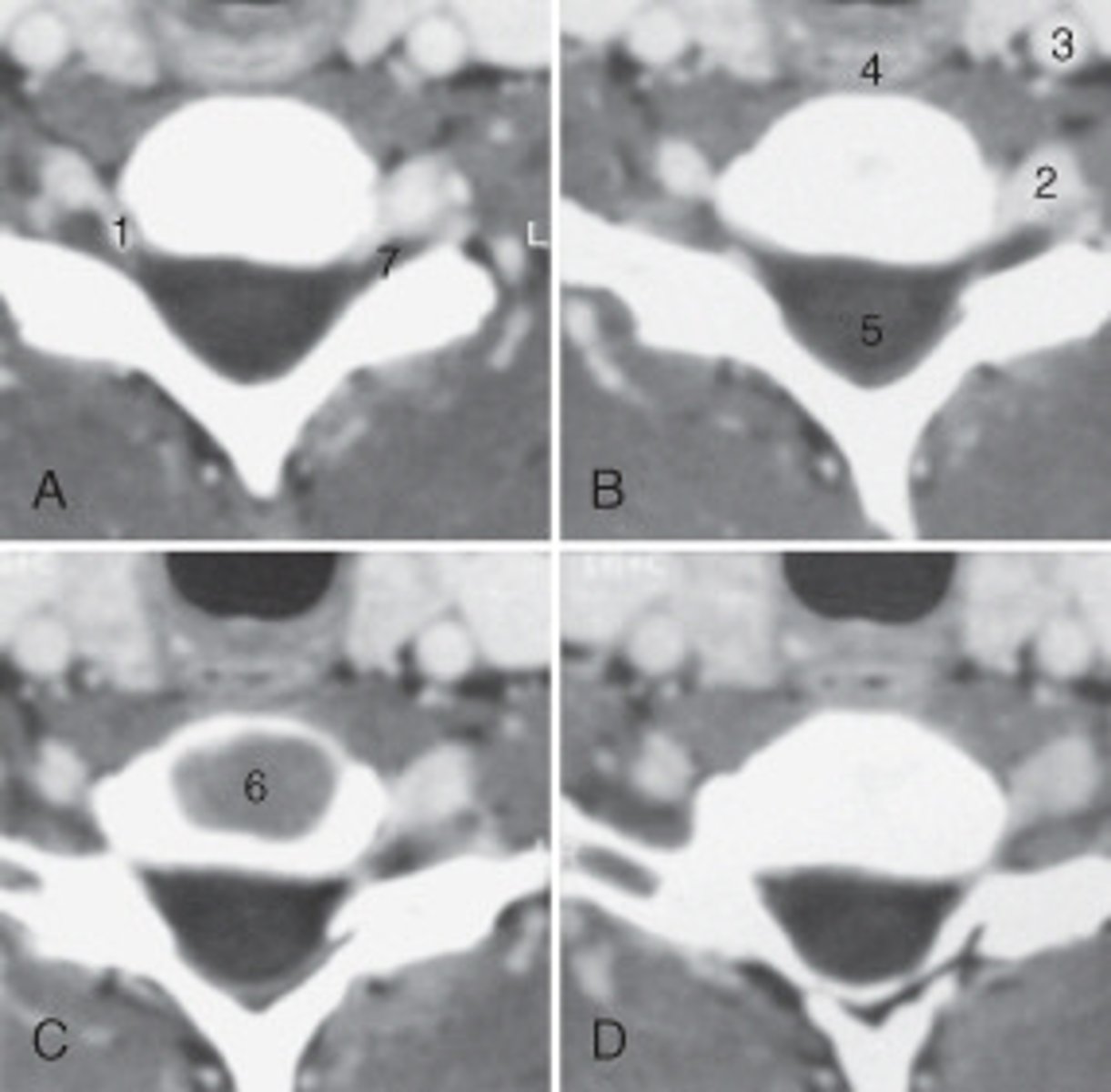 <p>the intervertebral disk is labeled:</p>