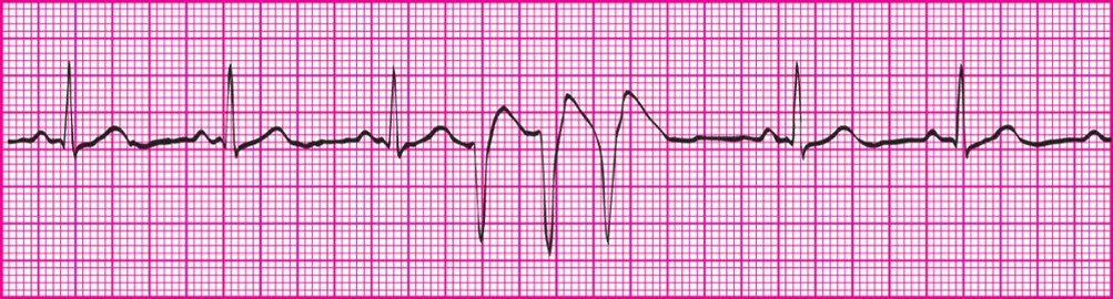 <p></p><p>Three or more PVCs occuring in a row at a rate greater than 100bpm</p>