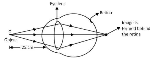 <ol><li><p>It is a convex lens and the defect is hypermetropia</p></li></ol><p></p>