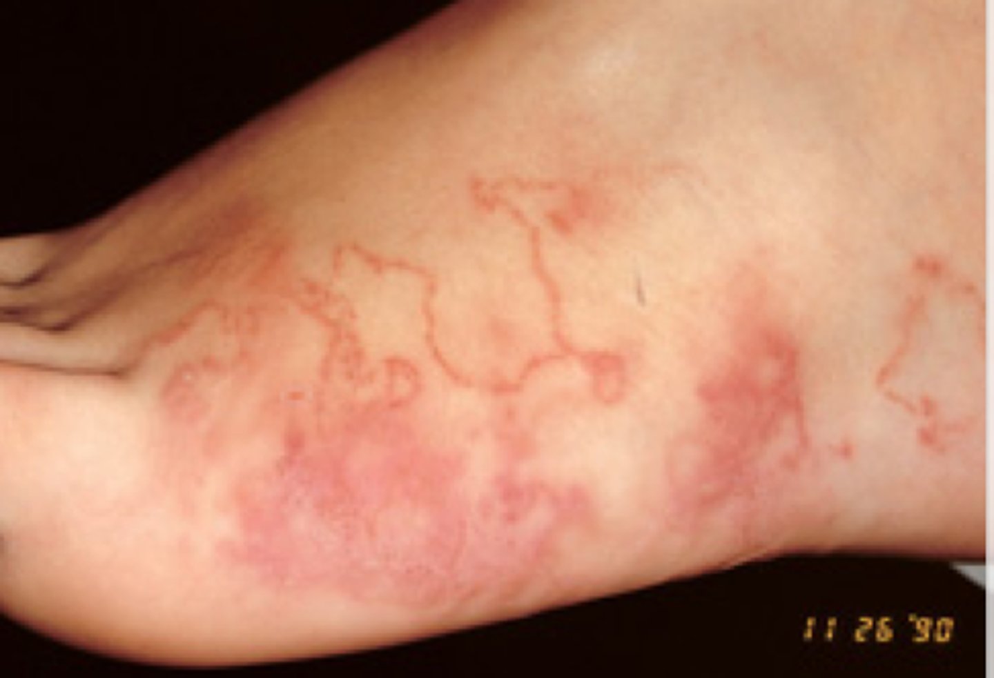 <p>cutaneous larva migrans</p><p>-accidental host disease</p>