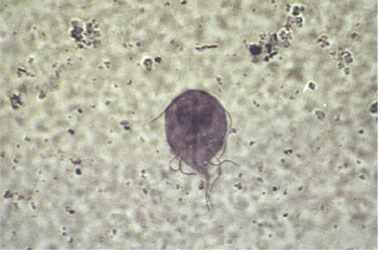 <p>Which intestinal protozoa is transmitted by <strong>waterborne</strong>, <strong>food-borne</strong>, <strong>fecal</strong>-<strong>oral</strong> <strong>routes</strong> and causes <strong><span>giardiasis </span></strong><span>(foul smelling, fatty, watery diarrhea)? </span></p><ul><li><p><span>most commonly diagnosed parasitic intestinal disease in US (hikers)</span></p></li><li><p><span>ingestion of </span><strong><span>raw/undercooked food</span></strong><span> contaminated with cysts or via food contaminated after cooking</span></p></li><li><p><strong><span>person-to-person</span></strong><span> transmission in childcare settings</span></p></li></ul>