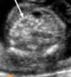 <ol><li><p>What pathology is seen if the gain were turned down and it matched the echogenicity of the fetal bone?</p></li><li><p>Name at least 1 pathology question 1’s answer can be associated with.</p></li></ol><p></p>