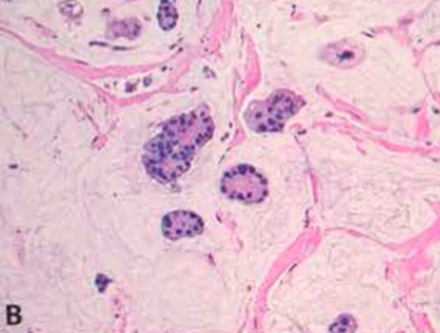 <p>Define Type of Breast Cancer:</p><p>D/t abundant extracellular mucin --&gt; Tumor cells floating in mucin pool</p><p>-Prog: GOOD!</p>