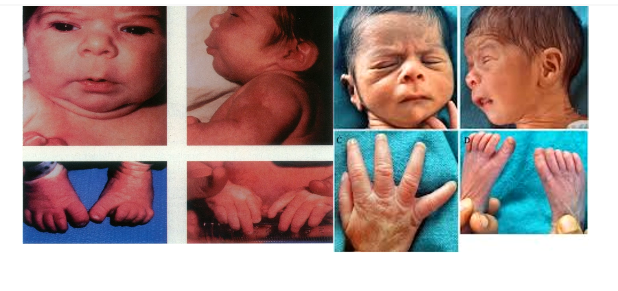 <p>What condition is this?</p><ul><li><p>Low birth weight</p></li><li><p>Short stature</p></li><li><p>Microcephaly</p></li><li><p>Cleft lip</p></li><li><p>Flat nasal bridge</p></li><li><p>hypoplastic nails/phalanges- there is absence of distal phalanges</p></li><li><p>Developmental delay and cognitive deficits<br></p></li></ul><p></p>