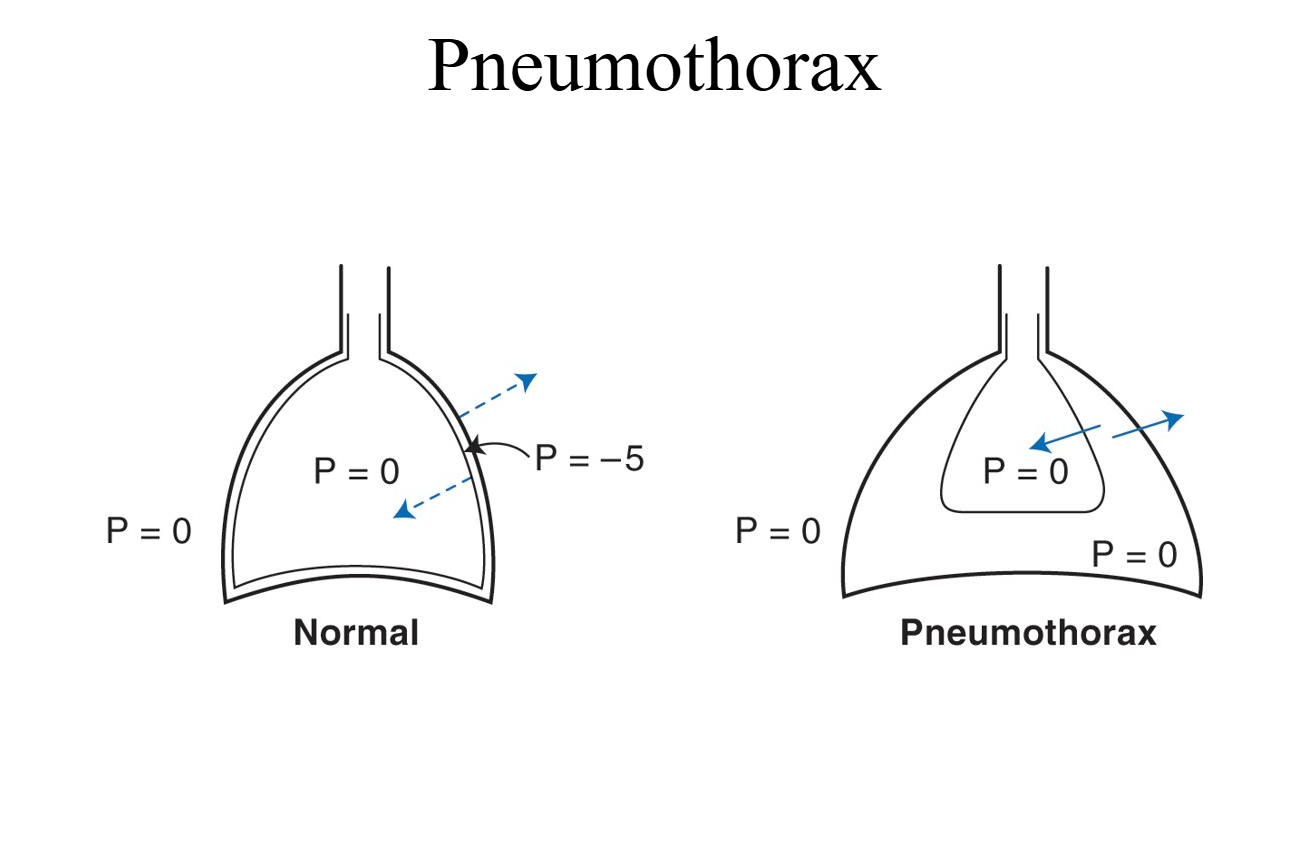 <ul><li><p><strong>Normal:</strong> The lung stays inflated because of the gentle vacuum.</p></li><li><p><strong>Pneumothorax:</strong> Air cancels the vacuum, the lung has nothing holding it open ā it collapses.</p></li></ul><p>Pneumothorax: Presence of air or gas in the cavity between the lungs and chest wall, causing collapse of the lung</p><p></p>