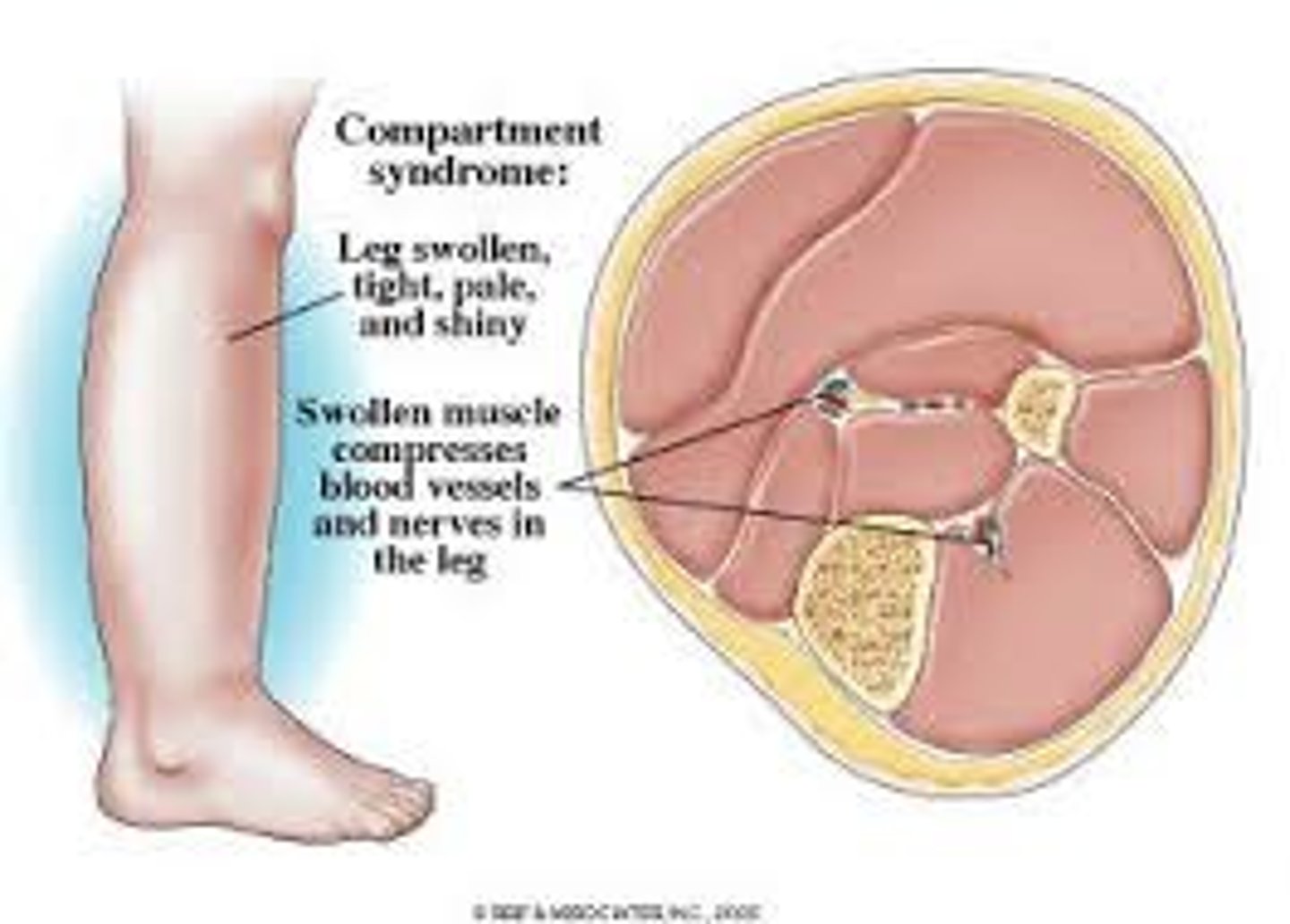 <p>Compartment syndrome (chronic exertional to be specific)</p>