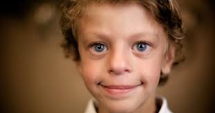 <p>Aplanamiento del puente nasal con punta nasal hacia arriba. Surco nasolabial. Labios prominentes con tendencia a la boca abierta. Epicanto. Problemas dentales.</p>