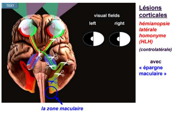 <p>c’est l’attente d’une partie du réseau visuel </p><p>Les voies visuelles croisent de façon très caractéristique. Les nerfs optiques se rapprochent et sous le cerveau, en avant de l’hypophyse, ils croisent partiellement. La partie nasale croise et pas la partie temporale. Après ce croisement = chiasma optique : il y a des bandes se substances blanches jusqu’au corps géniculé du thalamus.</p><p>Epargne maculaire : vision centrale préservée. Donc le patient ne le remarque pas tout de suite.</p><p>En d’autres mots, rappelons-nous que les voies de la vision croisent partiellement (carrefour d’échange de nerfs optiques) ; chaque œil envoie ses fibres à moitié droite et à moitié gauche.</p><p>➢ Partie nasale de l’œil gauche et partie temporale de l’œil droit.</p><p>La raison de ce croisement est de ne pas voir double, cela permet de voir une seule image avec les deux yeux.</p><p>S’il n’y a pas de croisement, la vision est dédoublée. S’il y a lésion sur le nerf optique (avant le chiasma) : atteinte de tout ce qui vient dans l’œil touché mais l’autre œil peut pallier MAIS vision plate. En effet, avec les deux yeux, nous avons une vue stéréoscopique (avec des reliefs) mais avec un seul œil, la vision est plate.</p><p>S’il y a lésion après chiasma : si la lésion est à droite, le problème se situera à gauche et inversement (dans ce cas, fermer un œil ne sert à rien ; les deux yeux envoient des fibres coupées). Les deux yeux sont donc touchés.</p>