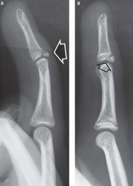 <p>What type of fracture is this?</p>