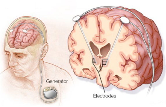 <p>Electrodes implanted in the brain <span style="color: red">stimulate </span>a target area with continuous pulses of low-voltage electrical current <span style="color: red">to facilitate behavior.</span></p><ul><li><p>Can be used for treatment of Parkinson’s disease, though not often used as it is invasive. </p></li></ul><p></p>