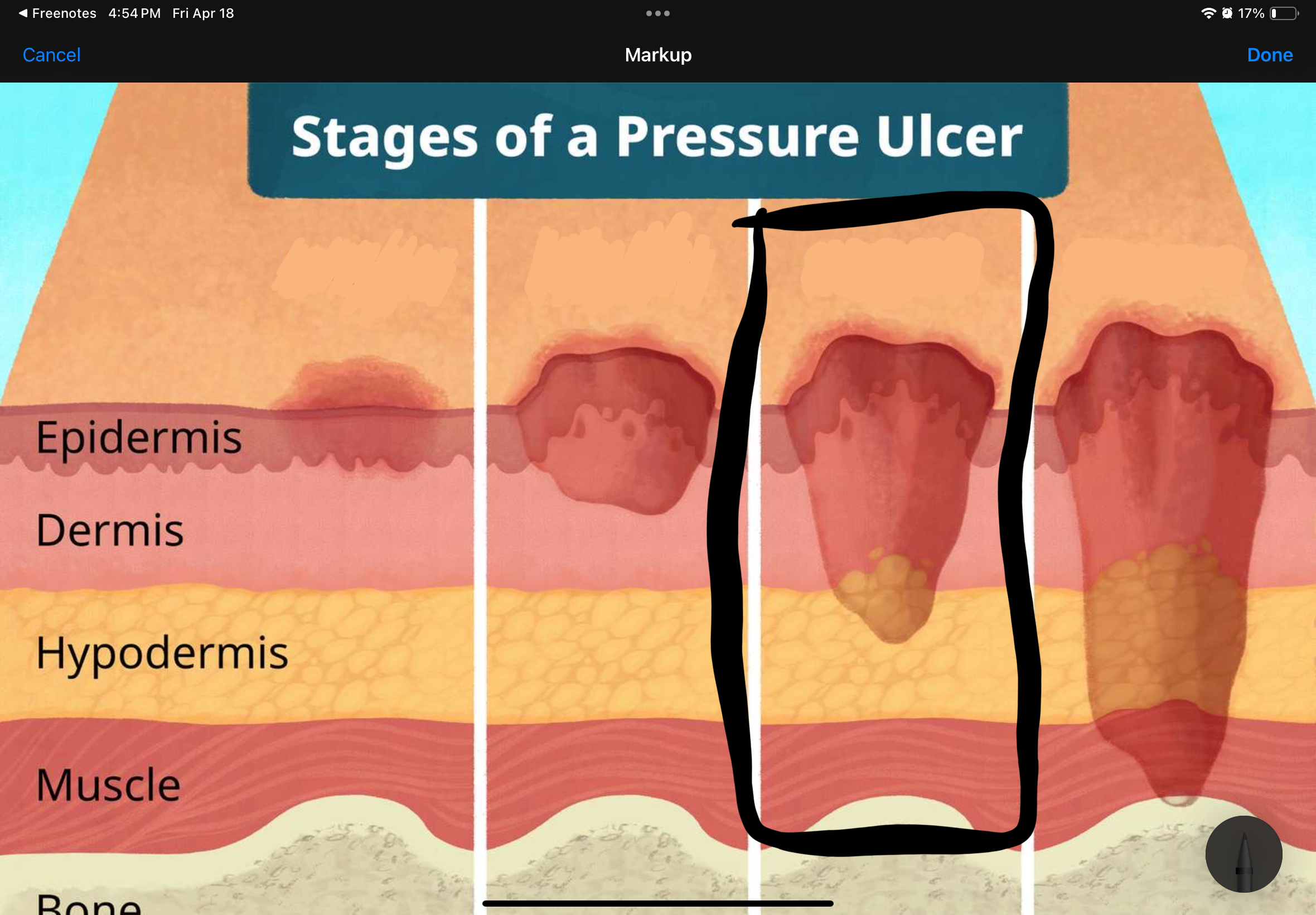 <p>Name and describe the stage of this pressure uncler</p>