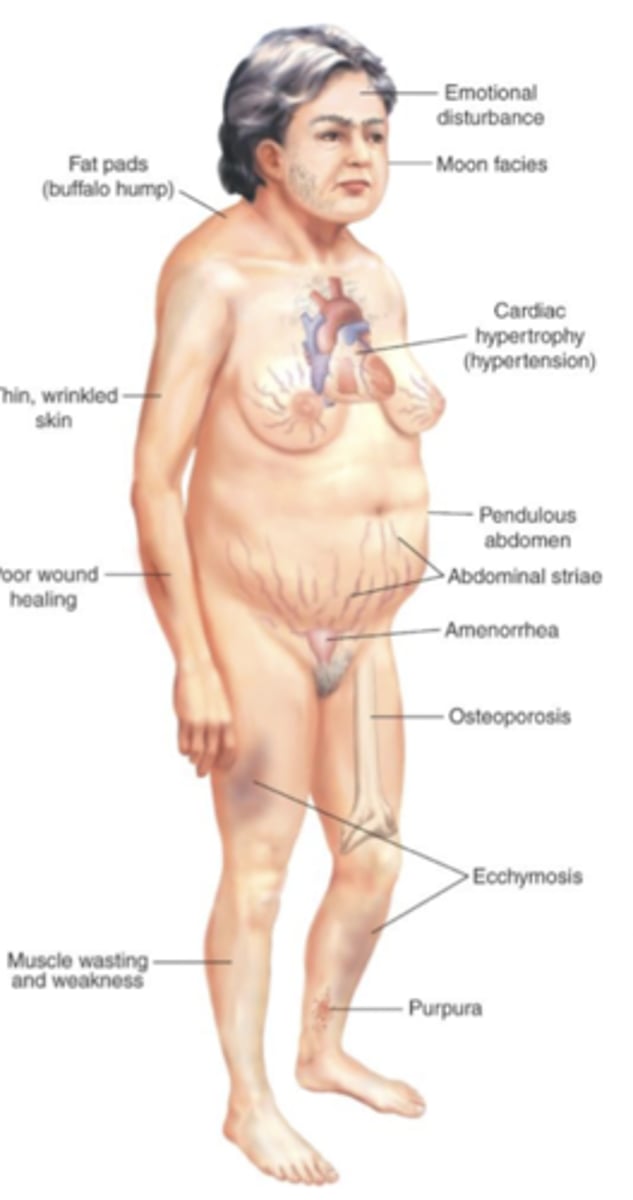 <p>round and ruddy face, truncal obesity with fat pad between scapulae, thin limbs and hair, fragile skin and striae</p>