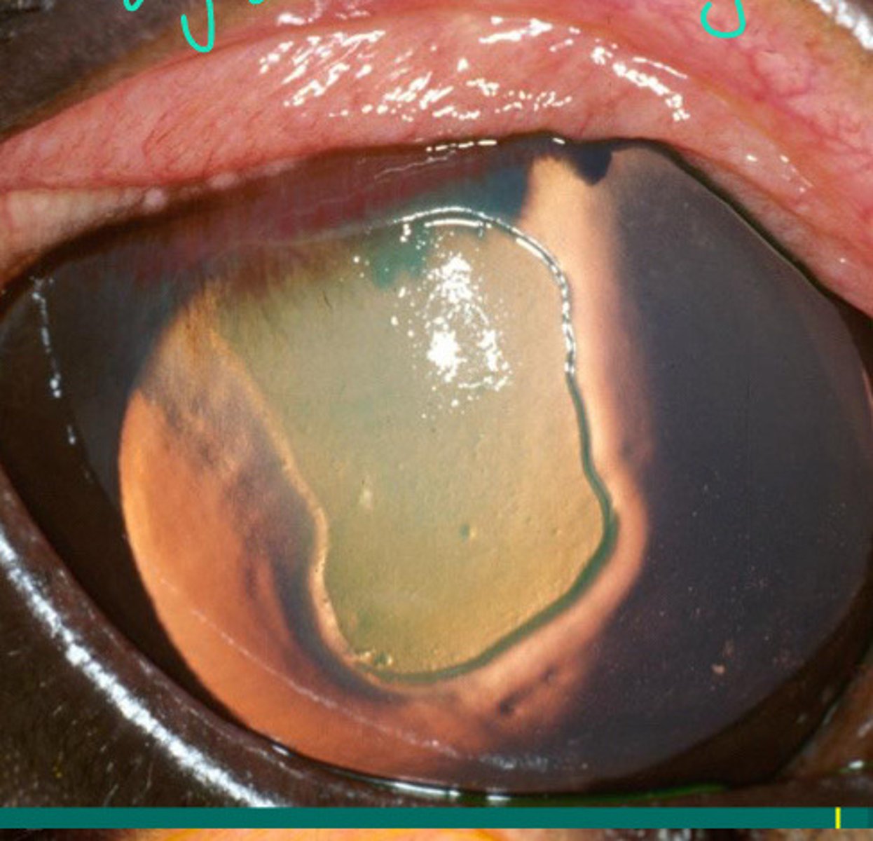 <p>Describe the edges of this lesion and what this means for debridement</p>
