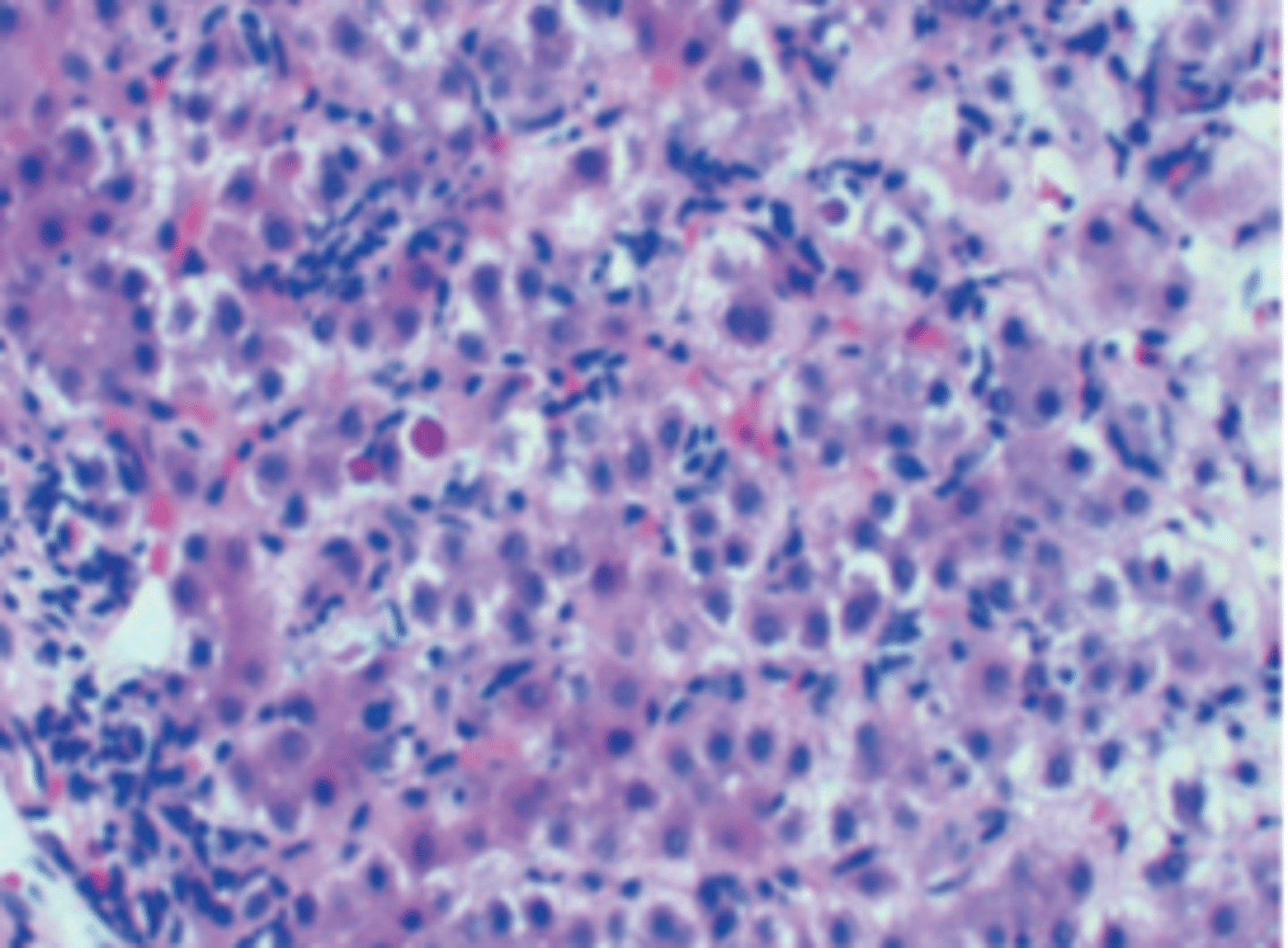 <p>A previously healthy 38-year-old man complains of yellow discoloration of his eyes, abdominal pain, and low-grade fever of 1-month duration. Physical examination demonstrates a distended abdomen, right upper quadrant tenderness, and a palpable liver edge 2 cm below the right costal margin. Total serum bilirubin is 7.4 mg/dL. Serum levels of AST and ALT are elevated (229 and 495 U/L, respectively). The prothrombin time is prolonged (18 seconds). A liver biopsy is shown in the image. The arrows point to Councilman bodies. The pathologic ﬁndings are indicative of which of the following liver diseases?</p><p>(A) Acute viral hepatitis</p><p>(B) Alcoholic cirrhosis</p><p>(C) Cardiac cirrhosis</p><p>(D) Hemochromatosis</p><p>(E) Primary biliary cirrhosis</p>