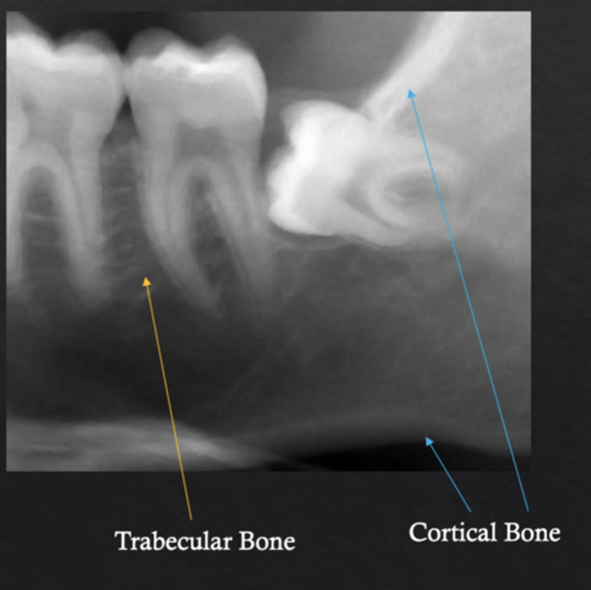 <p>Cortical bone and trabecular (cancellous) bone</p>