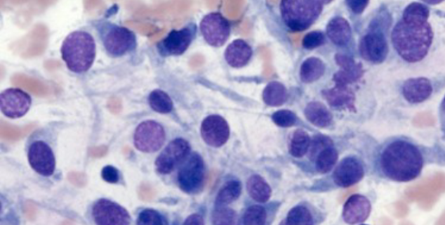 <p>The cytology slide pictured is most consistent with which of the following cell types?</p><p>A. Neuroendocrine epithelial neoplasia<br>B. Mesenchymal neoplasia<br>C. Lymphoma<br>D. Plasma cell</p>
