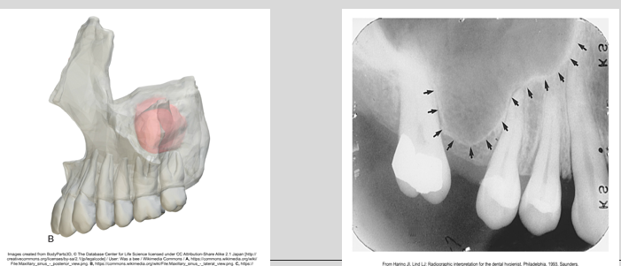 <p><span><span>·</span></span><span style="font-family: "Times New Roman"; line-height: normal; font-size: 7pt;"><span> </span></span><span><span>Paired cavities or compartments of bone located within the maxilla</span></span></p><p class="MsoListParagraphCxSpMiddle"><span><span>·</span></span><span style="font-family: "Times New Roman"; line-height: normal; font-size: 7pt;"><span> </span></span><span><span>Located above the maxillary premolar and molar teeth</span></span></p><p class="MsoListParagraphCxSpLast"><span><span>·</span></span><span style="font-family: "Times New Roman"; line-height: normal; font-size: 7pt;"><span> </span></span><span><span>A radiolucent area located above the apices of the maxillary premolars and molars</span></span></p>