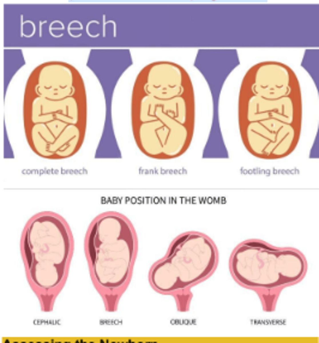 <p>baby's buttocks are the first part to emerge from the vagina</p><p>which can cause respiratory problems</p><p>▪ Complications: bleeding, infection, damage to pelvic organs, post-operative pains, riskier future pregnancies</p>