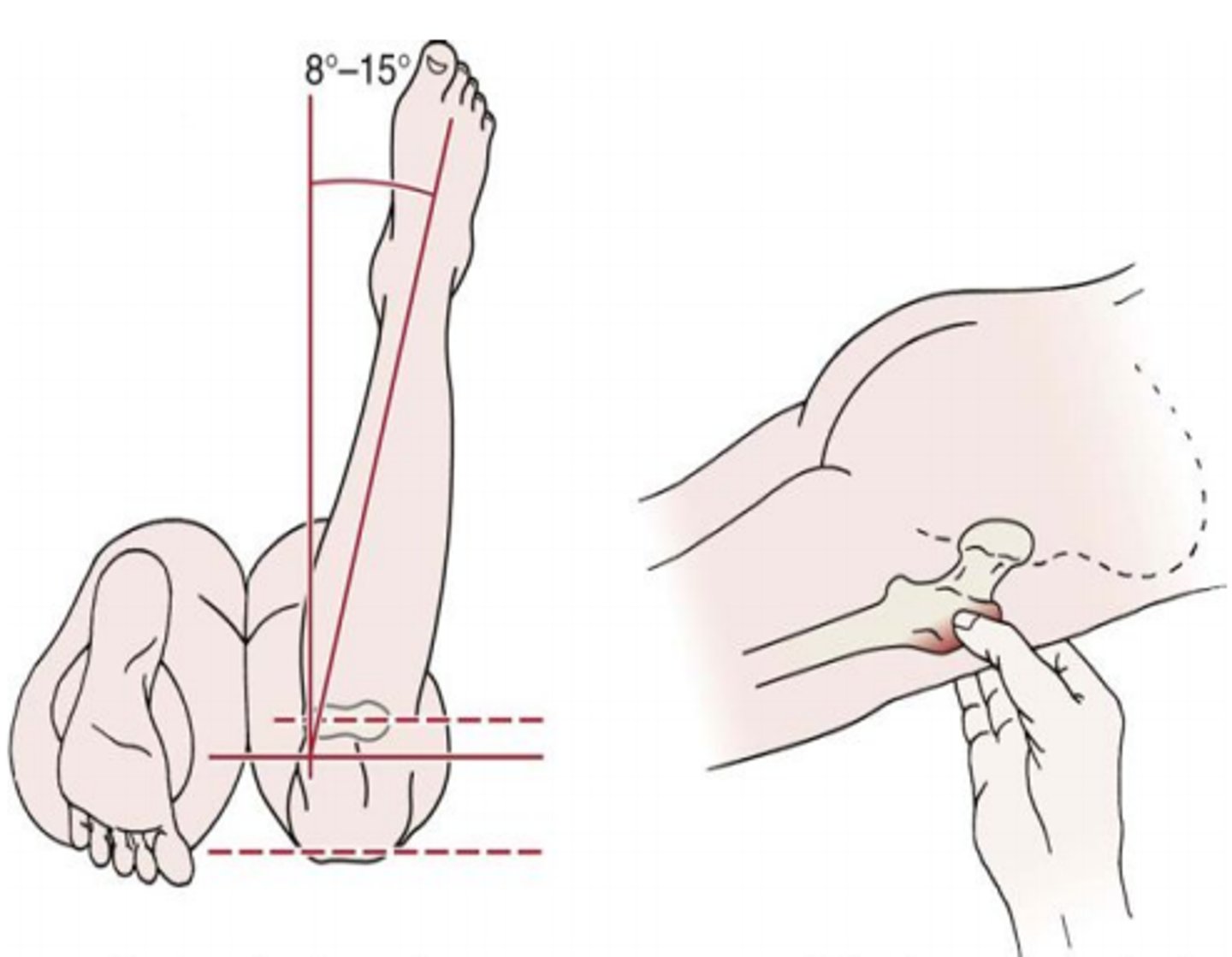 <p>Abnormal femoral anti-torsion angle</p>