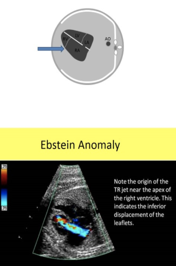 <p>ebstein anomaly is </p><p>a) abn placement of tricuspid valve more inferiorly into the apex of right ventricle</p><p>b) abn placement of tricuspid valve more inferiorly into the apex of left ventricle</p><p>c) abn placement of the mitral + tricuspid valves more inferiorly into the apex of the ventricles</p><p>d) abn placement of the mitral valve more inferiorly into the apex of left ventricle </p>