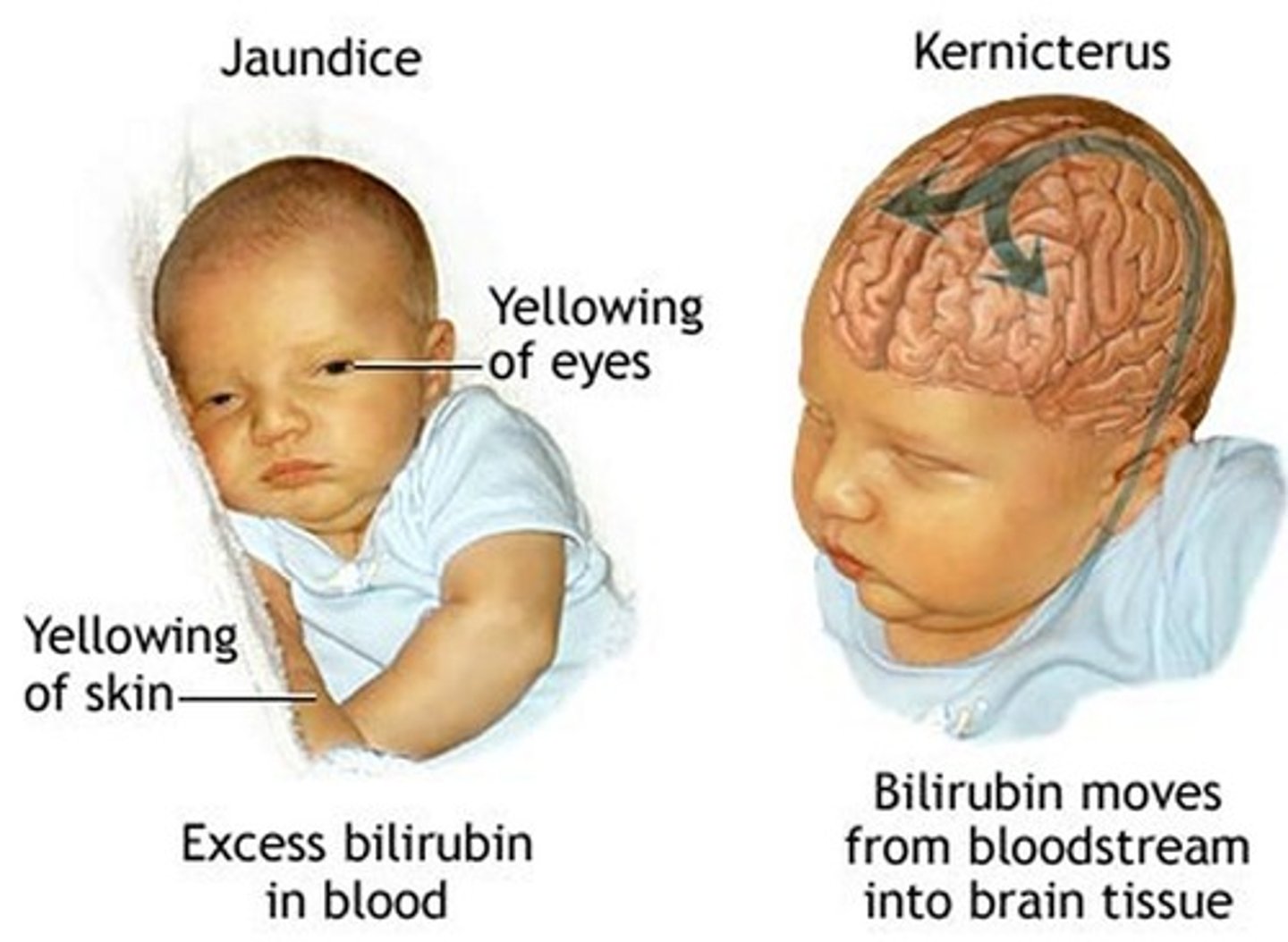 <p>yellowing of the skin and the whites of the eyes caused by an accumulation of bile pigment (bilirubin) in the blood</p>