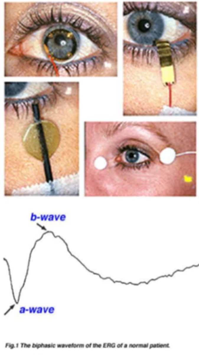 <p>CL on the front of the eye measures the mass electrical response of the retina to photopic stimulation </p>