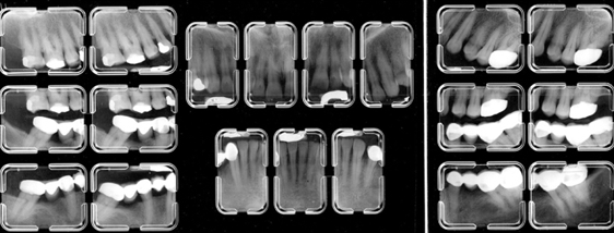 <ul><li><p><span>also known as CMS or FMS</span></p></li><li><p><span>a full-mouth series or complete series that consists of tooth-bearing areas (dentulous or edentulous areas)</span></p></li><li><p><span>includes periapical and bitewings</span></p></li><li><p><span>14 to 20 films may be taken</span></p></li></ul><p></p>