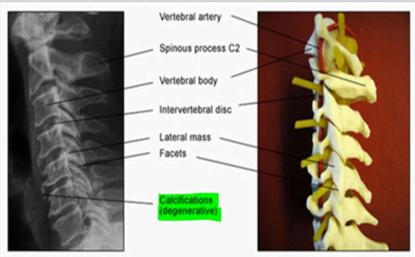 <p>cervical spine appears very straight with a variance in disc space &amp; body size</p><p>*calcifications (degenerative) also common</p>