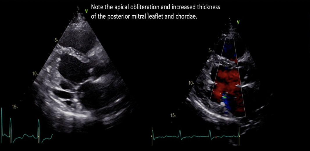 <ol><li><p>Endocardial thickening </p></li><li><p>Fibrous tissue overgrowth LV apex </p></li><li><p>Diastolic dysfunction </p></li></ol><p></p>