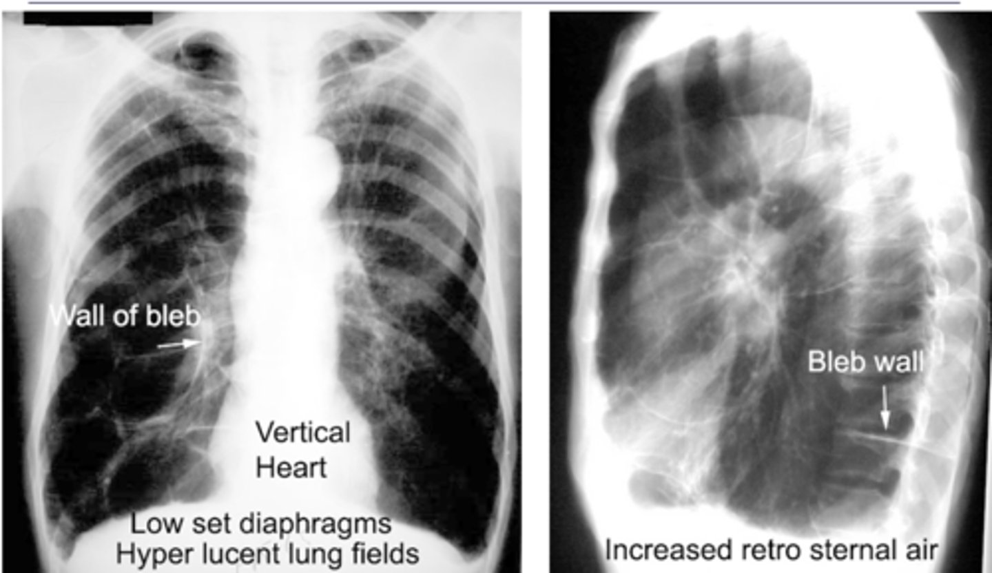 <p>What are blebs and bullae - what findings would you find on xray?</p>