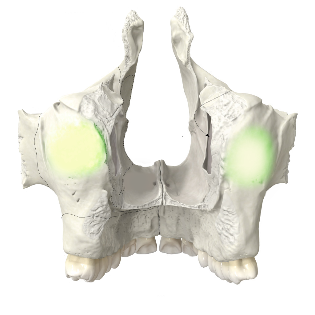 <p>felső állcsonti dudor</p>